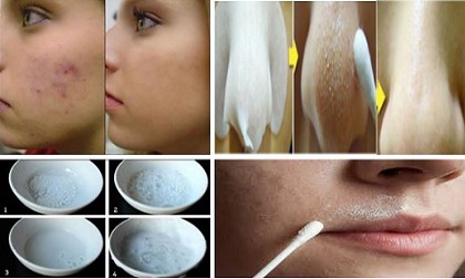 Mụn mãi không hết: Thử cách sau và bạn sẽ không khỏi bất ngờ với làn da căng mịn và mềm mại