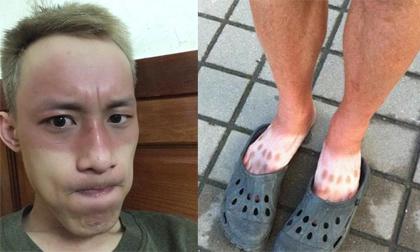 Cư dân mạng đua nhau 'khoe' ảnh da loang lổ vì nắng nóng