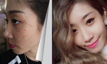 Thoát khỏi nám da mặt khi đặt niềm tin đúng chỗ - các bà mẹ thông thái chia sẻ