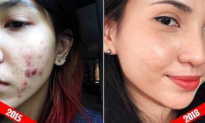 Tuyệt chiêu trị mụn của cô gái Việt được khen ngợi hết lời trên báo nước ngoài
