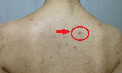 Rất nhiều người bị mẩn đỏ và nổi mụn ở lưng mà không biết - Đây chính là nguyên nhân