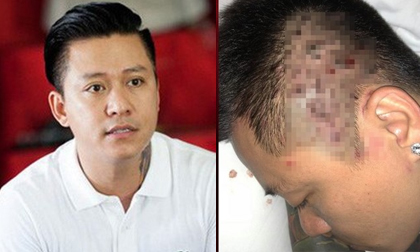 Tất cả những điều cần biết để phòng tránh căn bệnh quái ác mà ca sĩ Tuấn Hưng đang mắc phải