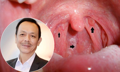 Bệnh ung thư NSƯT Thanh Hoàng mắc phải nguy hiểm thế nào?