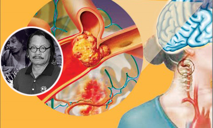 Dấu hiệu nhận biết bệnh tai biến mạch máu não và cách phòng tránh căn bệnh đã khiến 'Chí Phèo' Bùi Cường đột ngột qua đời 