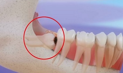 Bác sĩ khuyên cần nhổ răng khôn trước 25 tuổi, lý do vì sao?
