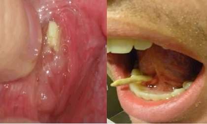 Chảy mủ, bị cộm dưới lưỡi, chàng trai nổi hết da gà khi ép được vật thể lạ này ra khỏi miệng