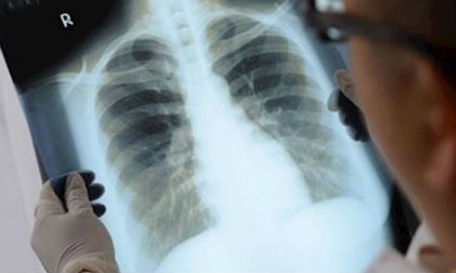 6 dấu hiệu của bệnh ung thư phổi bạn cần biết ngay, đau ngón tay tưởng đơn giản mà cũng là một trong số đó