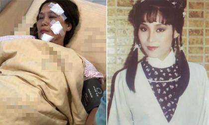 Mỹ nhân 'Anh hùng xạ điêu 1983' bỏng nặng vì trường quay bất ngờ bốc cháy