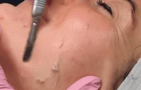 Cạo mặt làm đẹp là phương pháp gì?