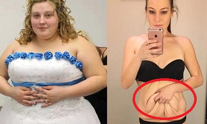 Tôi đã giảm được 90kg, nhưng khiến bụng bèo nhèo chảy xệ, phải làm thế nào?