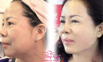 Không cần phẫu thuật nữa, đây mới là phương pháp căng da hiệu quả