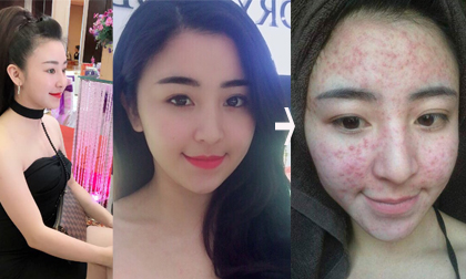 Bất ngờ với gương mặt chi chít mụn của 'Hotgirl bánh tráng' 