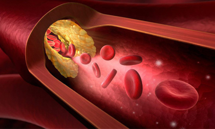 Không chỉ người béo, gầy cũng có thể bị mỡ máu cao: 6 thực phẩm nên ăn để 'tiêu' mỡ nhanh