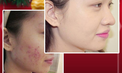 Cách để cô nàng 'thâm mụn' sở hữu làn da vạn người mê