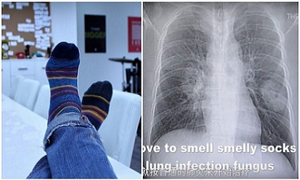 Thường xuyên ngửi tất của mình, người đàn ông phải nhập viện vì nhiễm trùng phổi nặng