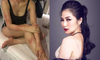 Mối nguy hiểm của căn bệnh ca sĩ Hương Tràm mắc phải