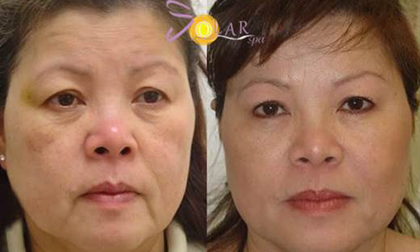 Căng da - xóa bọng mỡ mắt chỉ trong '90 phút' không phẫu thuật