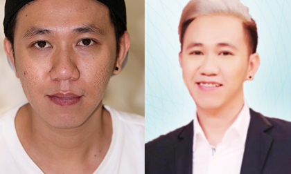 Chàng trai năm ấy 'diễn viên Anh Đức' đã lấy lại phong độ nhờ trị sạch sẹo rỗ