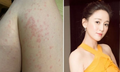 Sở hữu làn dan mịn màng tươi trẻ nhưng cũng có lúc Trần Kiều Ân bị nổi mẩn kinh dị như thế này 