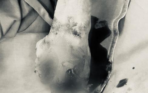 iPhone phát nổ lúc đang sạc, thiếu niên 13 tuổi mất bàn tay trái