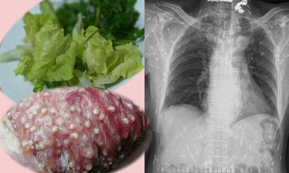 Từ vụ nhiễm sán lợn: Đây mới là con đường dẫn đến bị nhiễm sán kinh hoàng nhất