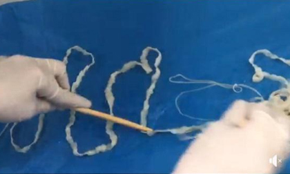 Kinh hãi bác sĩ 'bắt' sán lợn dài 5,2 mét trong cơ thể cô gái trẻ