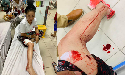 Thúy Nga đăng hình bị tai nạn máu me đầm đìa khiến nhiều người lo lắng