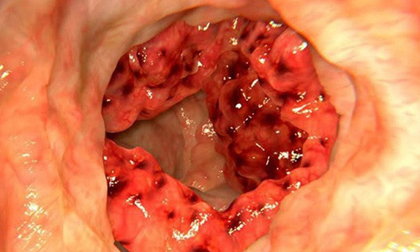 Ung thư đại trực tràng: Người và nghề nào sẽ có nguy cơ mắc bệnh cao?