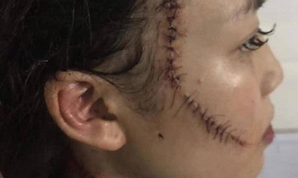 Chị gái thiếu nữ xinh đẹp bị rạch mặt: “Em tôi kêu có thai mà họ vẫn không tha”