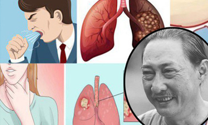 Chỉ sau 1 năm chống chọi với ung thư phổi, nghệ sĩ Lê Bình qua đời: Đừng bỏ qua các dấu hiệu cảnh báo bệnh sớm