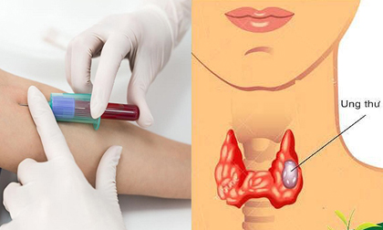 Nếu không muốn mắc ung thư, phụ nữ từ 20-40 tuổi nhất định phải làm 6 xét nghiệm cực quan trọng này