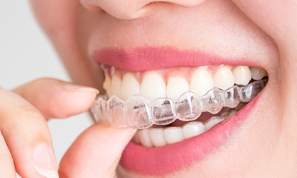 Niềng răng tháo lắp giá bao nhiêu và 5 lưu ý quan trọng bạn nên biết