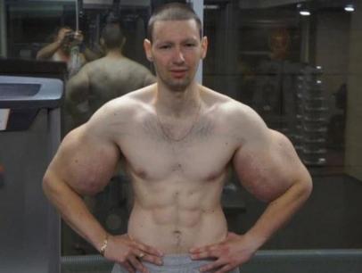 Chàng trai tiêm dầu vào cơ bắp cầu cứu vì nhiễm trùng