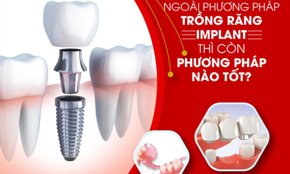 Ngoài trồng răng Implant thì còn phương pháp nào tốt?