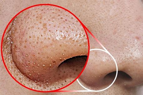 4 công thức giúp làm sạch da, ngăn ngừa mụn đầu đen