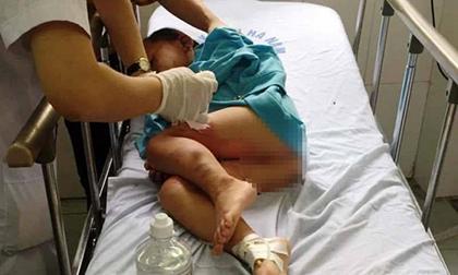 Cô giáo mầm non đổ cồn vào mâm châm lửa để dạy trẻ phòng cháy, 3 bé bỏng nặng