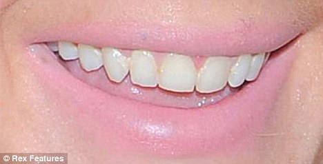 Lindsay Lohan,lộ,răng... sún