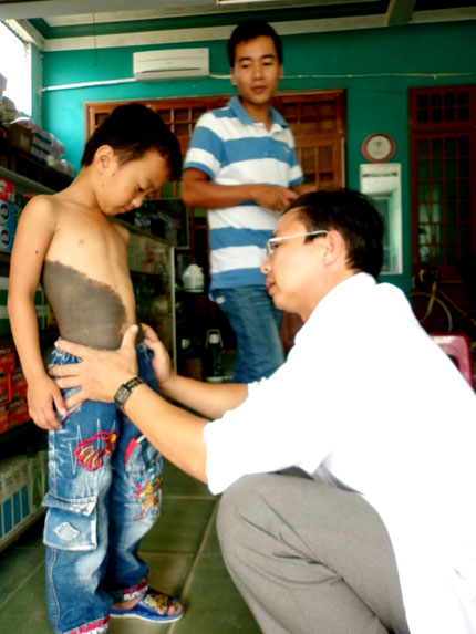 bé 'người sói',bác sỹ Phan Đình Mỹ,bệnh “bớt tăng sắc tố”