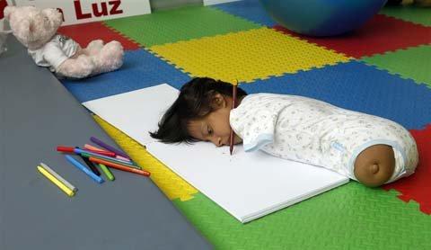 chuyện lạ,chuyện lạ thế giới,phi thường,kỳ quặc,mắc bệnh,Yovana Yumbo Ruiz