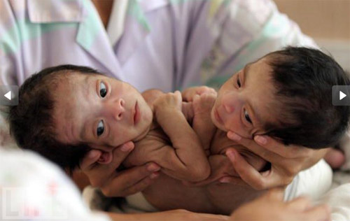 sinh đôi,dính liền,kỳ lạ,sinh đôi dính liền