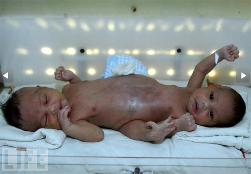sinh đôi,dính liền,kỳ lạ,sinh đôi dính liền