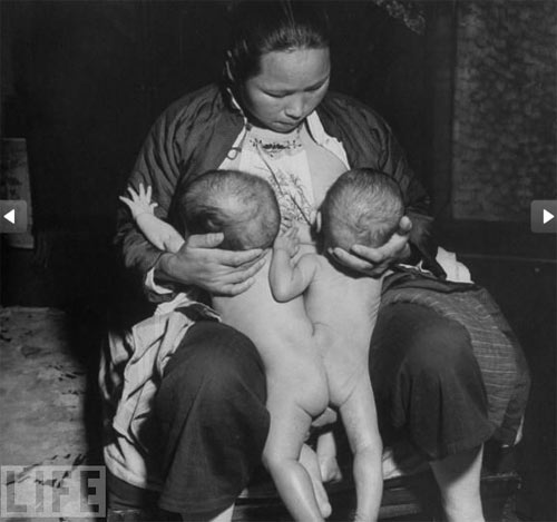 sinh đôi,dính liền,kỳ lạ,sinh đôi dính liền