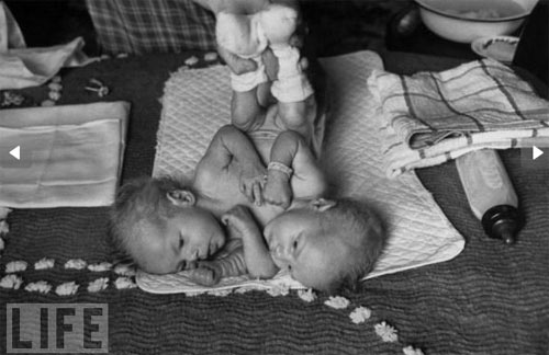 sinh đôi,dính liền,kỳ lạ,sinh đôi dính liền