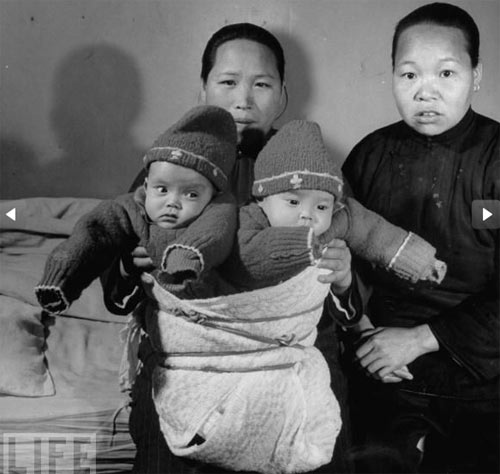 sinh đôi,dính liền,kỳ lạ,sinh đôi dính liền