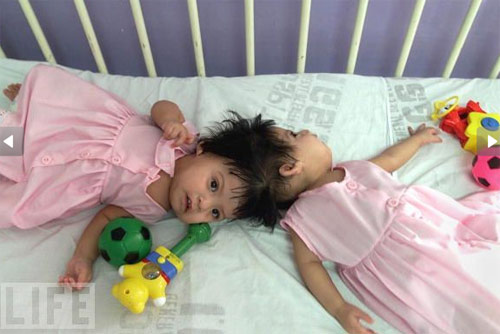sinh đôi,dính liền,kỳ lạ,sinh đôi dính liền