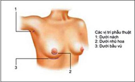 thẩm mỹ viện thanh bình,phẫu thuật thẩm mỹ,nâng ngực,làm đẹp