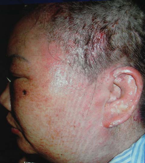  Nhuộm tóc,mối nguy tiềm ẩn,dị ứng mạnh với thuốc nhuộm tóc,không ít trường hợp tử vong.