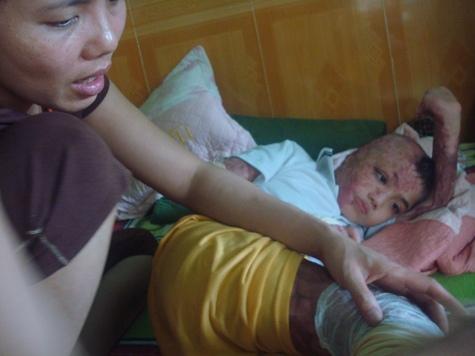 Cháu bé bỏng nặng,lấy da vá da,cháu bé bỏng được hỗ trợ