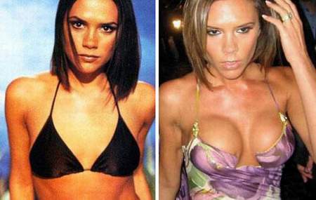 ngực,dao kéo,phẫu thuật,nâng ngực,sao Hollywood,Pamela Anderson,Rihanna 