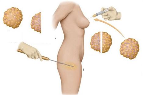 Thẩm mỹ,nâng ngực,bác sĩ,phái đẹp
